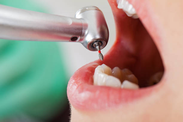 Best Emergency Dentist for Knocked-Out Tooth in Conestee, SC